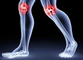 Causas del desarrollo articular de las articulaciones de la rodilla