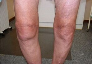 Cómo tratar las articulaciones de la rodilla