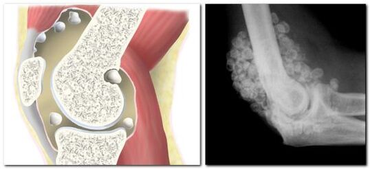 Condromatosis con dolor de cadera.