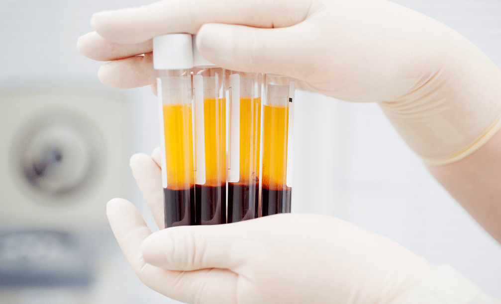 Plasma rico en plaquetas para el tratamiento de la artritis con PRP