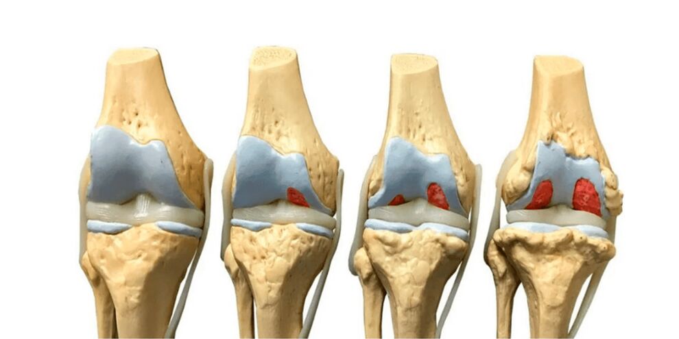 Grado de artritis en la articulación. 